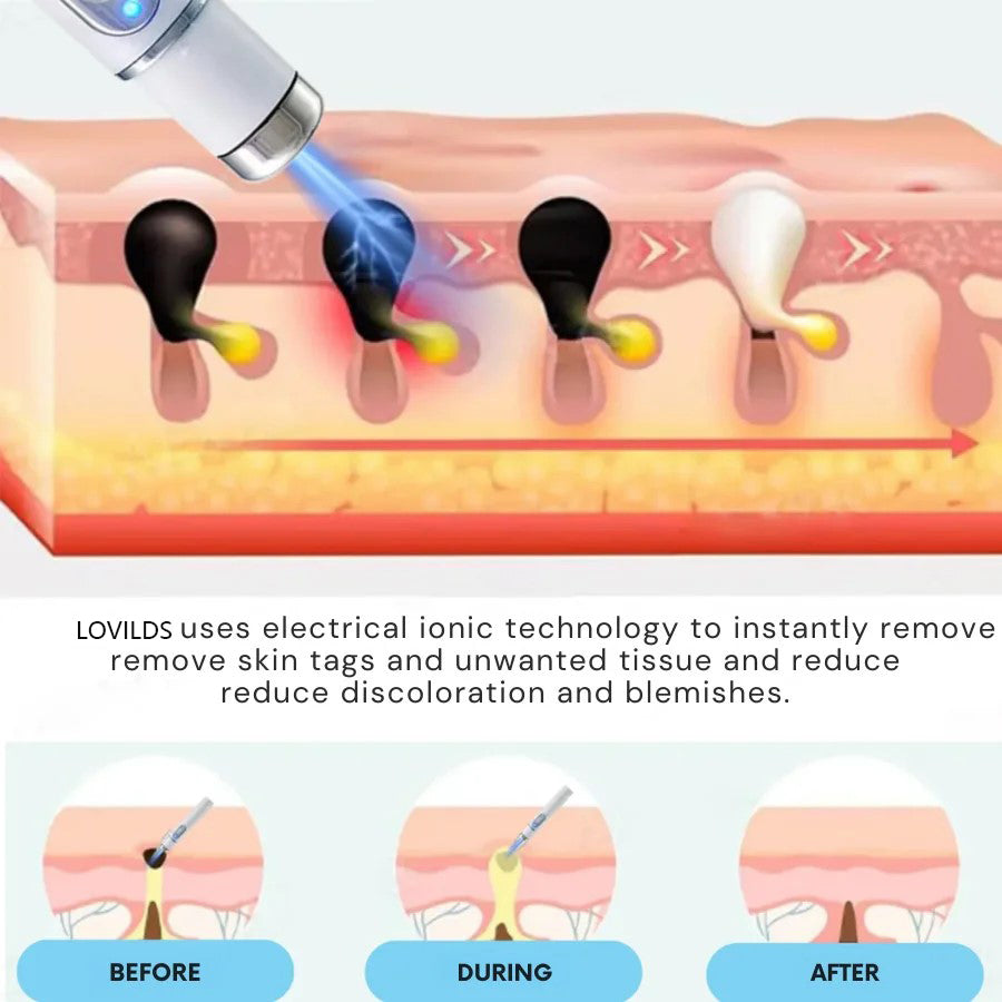 Removal Laser Pen