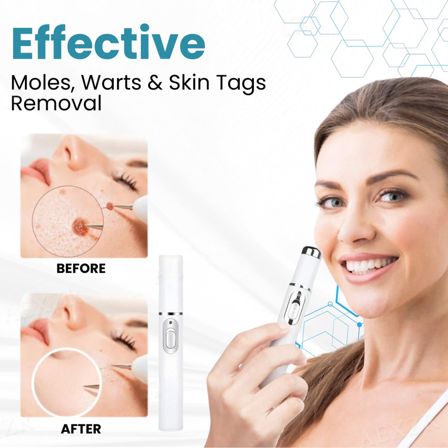 Removal Laser Pen