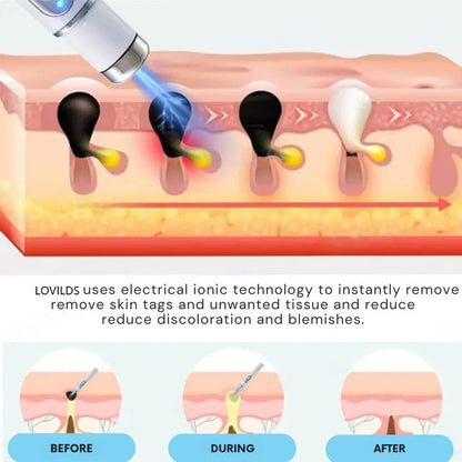 Removal Laser Pen